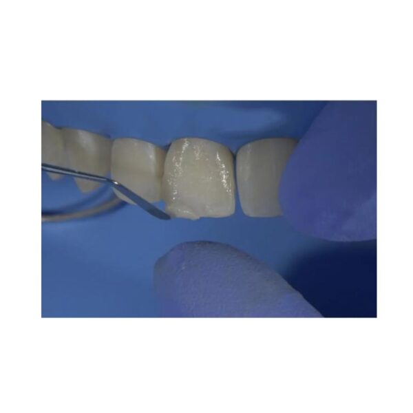 GDC Restore Instrument – Applica