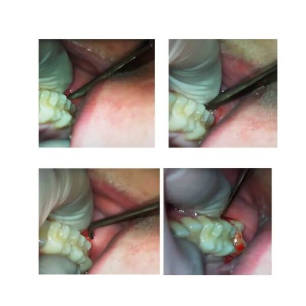 GDC Root Elevators Warwick James Set Of 3 (Ewjs3)