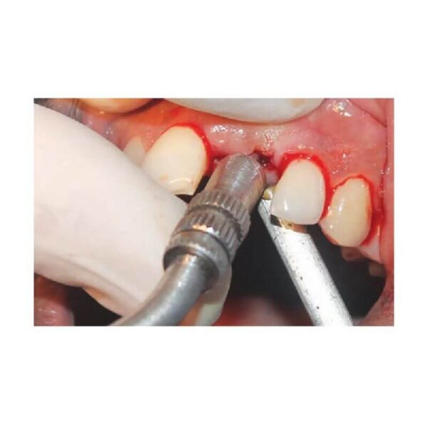 GDC Osteotome Concave Angulated Set Of 6 In Pouch (Ostmshsp6)